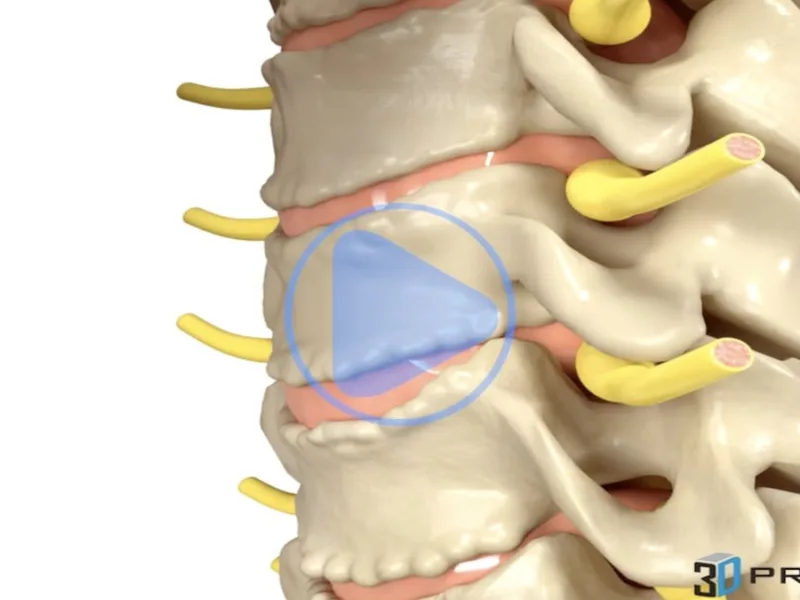 Cervical ROM - Degeneration — 3D anatomical animation