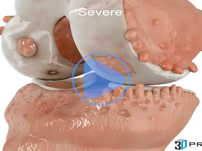Osteoarthritis — 3D anatomical animation