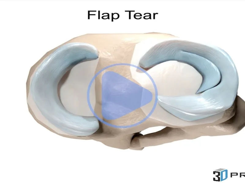Meniscus Injury — 3D anatomical animation