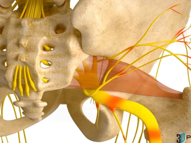 Sciatica — 3D anatomical animation
