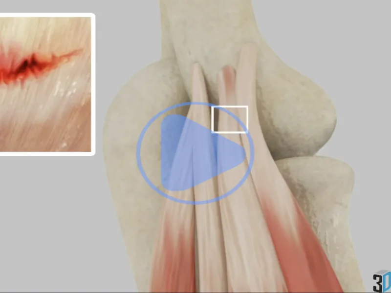 Epicondylitis — 3D anatomical animation