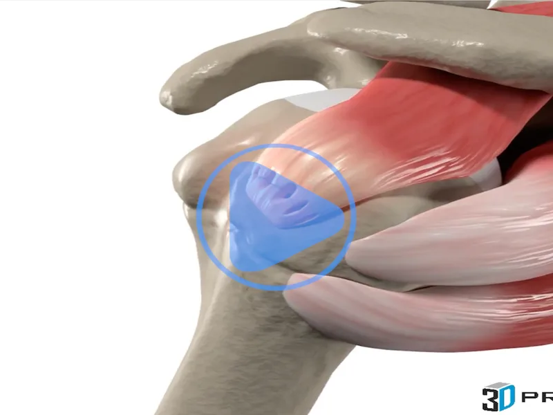 Rotator Cuff Injury — 3D anatomical animation