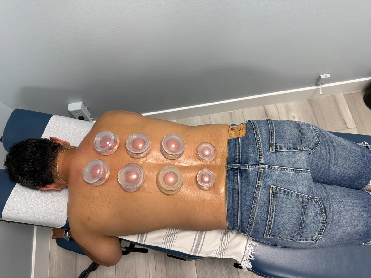How Cupping Therapy works at Divine Healing Chiropractic