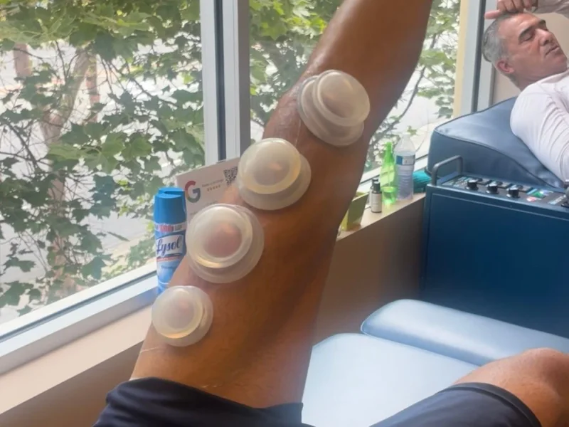 Cupping Therapy at Divine Healing Chiropractic in Laguna Niguel