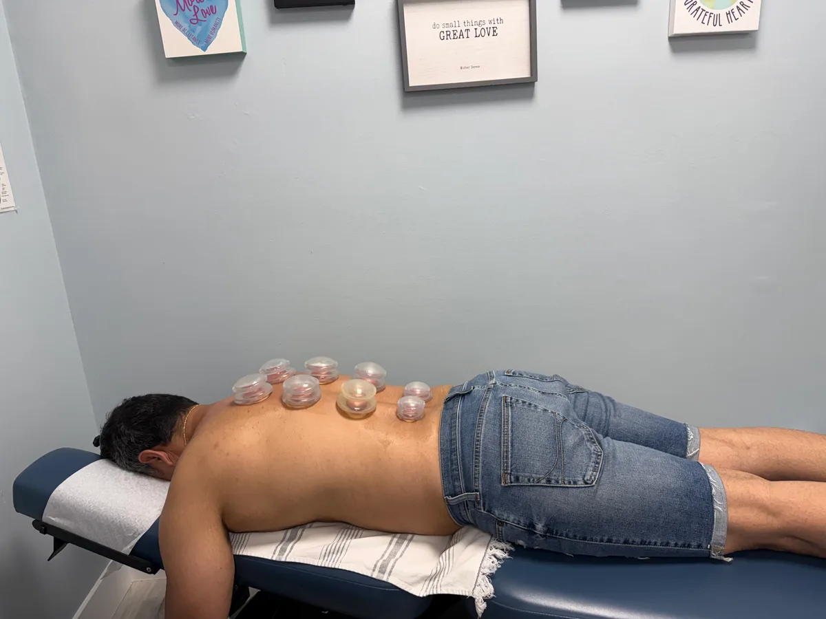 Cupping Therapy at Divine Healing Chiropractic in Laguna Niguel