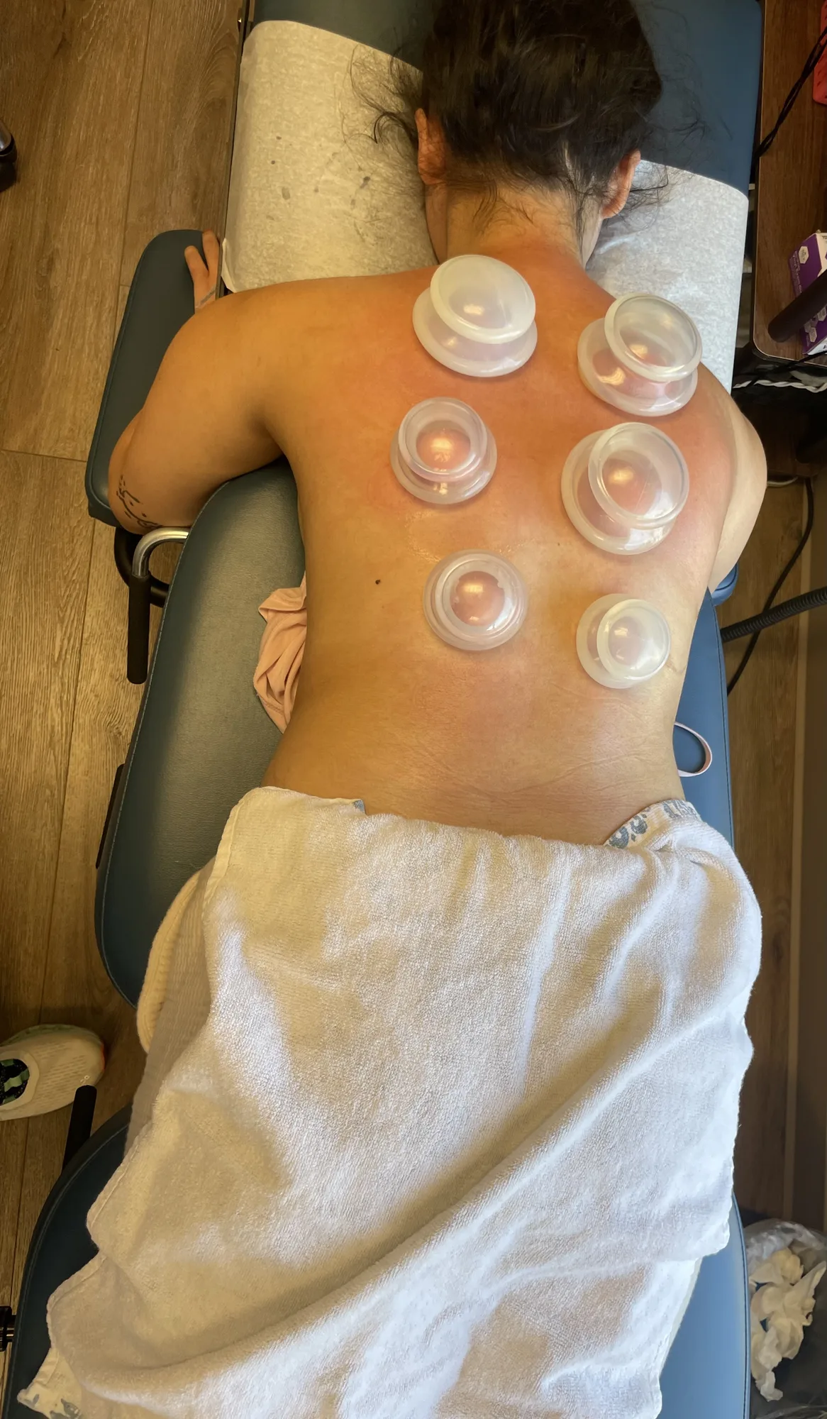 Cupping Therapy at Divine Healing Chiropractic in Laguna Niguel