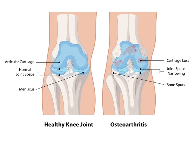 How Knee Decompression Therapy works at Divine Healing Chiropractic