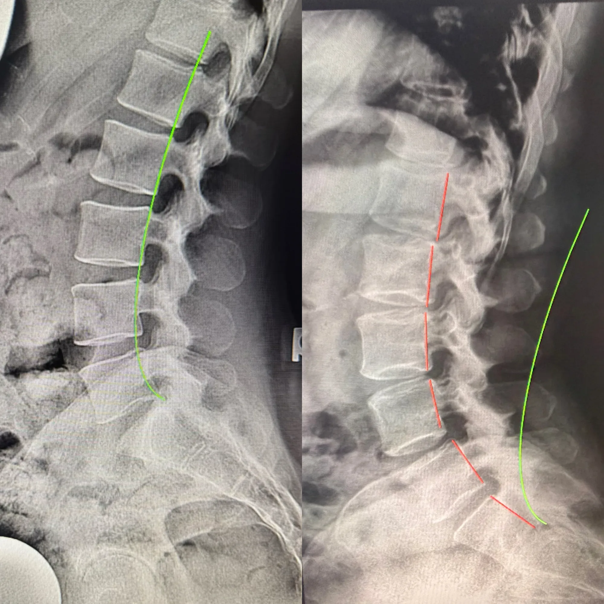 How Divine Healing Chiropractic treats sciatica in Laguna Niguel