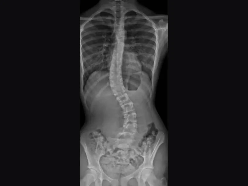 Divine Healing Chiropractic treating scoliosis in Laguna Niguel