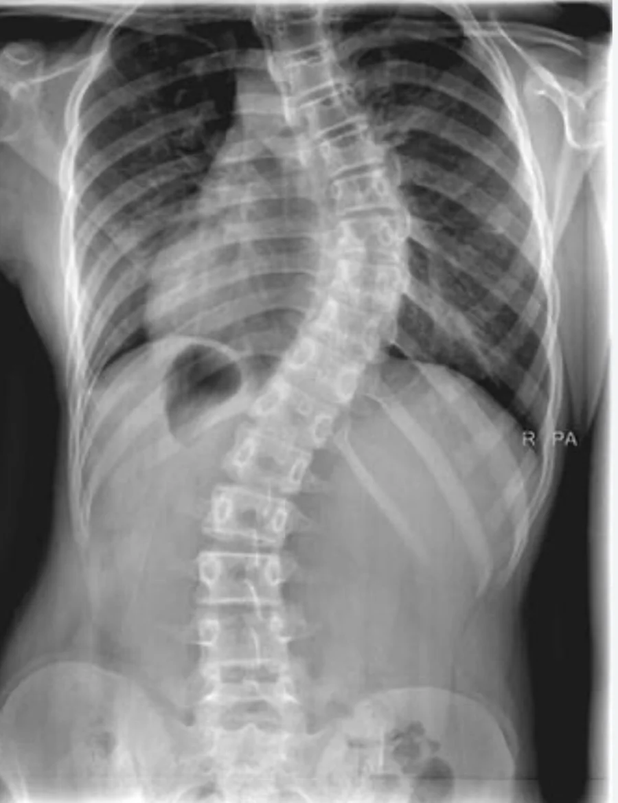 Radiograph of the thoracic and lumbar spine showing an S-shaped scoliotic curve